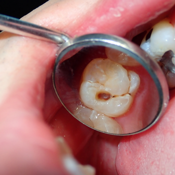 Dental Disease Prevention and Management at Dixit Dental Clinic